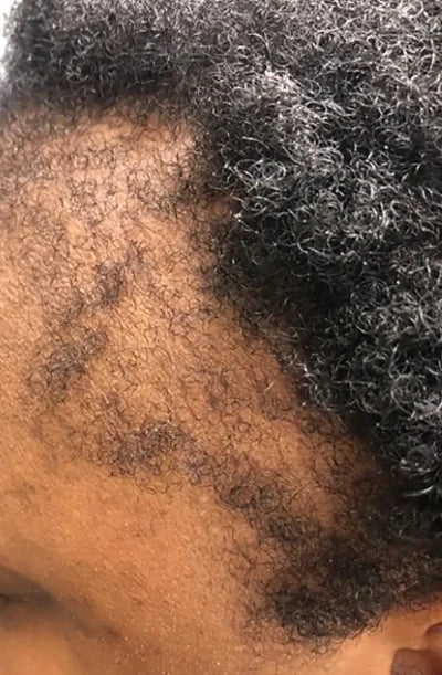 picture showing a hairline showcasing frontal causing hair loss